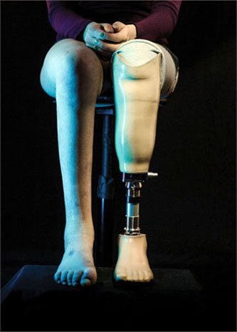 A woman with a prosthetic leg.