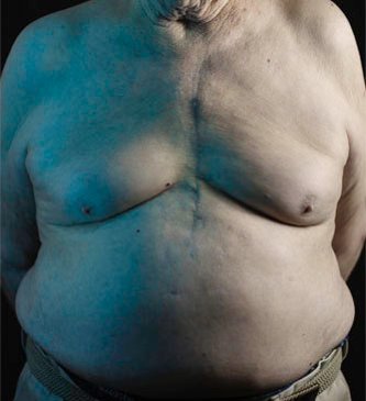 Man with a chest scar from bypass surgery.