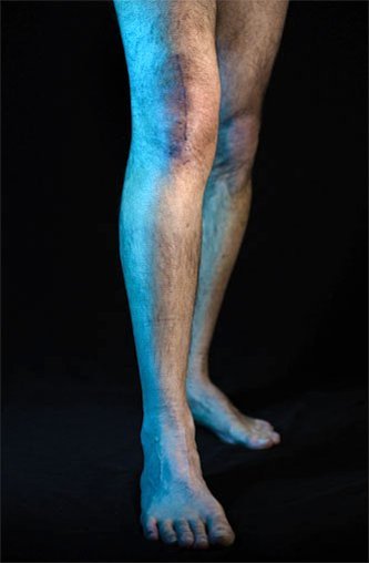 A person with scarring on their knee from a artificial replacement surgery.