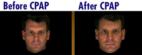 These images show a patient before and after CPAP treatment for sleep apnea. In the study, independent raters who didn't know which was which were able to tell the difference two-thirds of the time.   Photo: University of Michigan