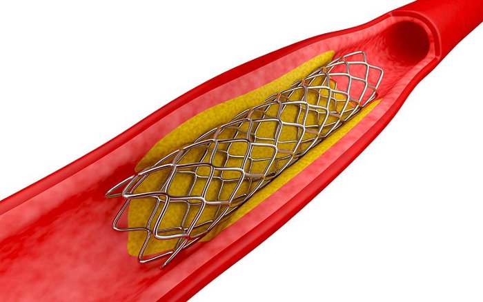 Over time, traditional wire mesh stents can break down, injure the blood vessel, and trigger inflammation or clot formation