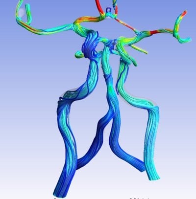 A streamline diagram of bloodflow analysis that helps determine the rise of an aneurysm bursting.