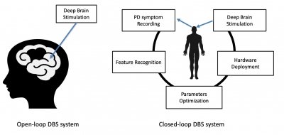 A closed loop system is a circular response to when a patient needs stimulus, incuding PD symptom recording, feature recognition, Parameters optimization, hardware deplayment, and deep brain stimulation, as shown in a circular format, while and open-loop system show provides continuous deep brain stimulation whether the patient needs it or not.