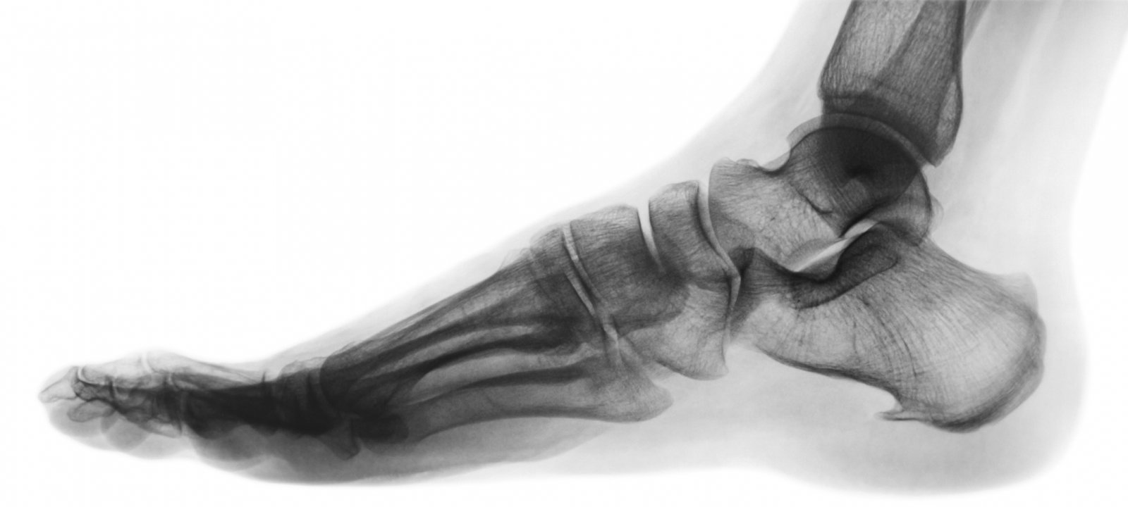 X-ray of a human foot