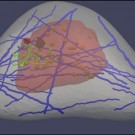 "Virtual Breast" Could Improve Cancer Detection